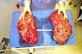 kidneys - iftikhar ul haq